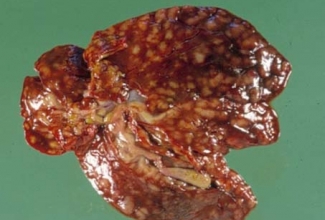 Koktsidioosis küüliku maks, foto Richard Hoop