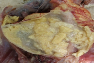 Rebuperitoniit, foto: https://www.ncbi.nlm.nih.gov/pmc/articles/PMC3805102/